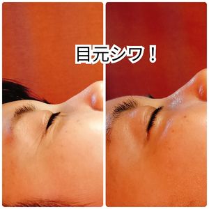しわ改善