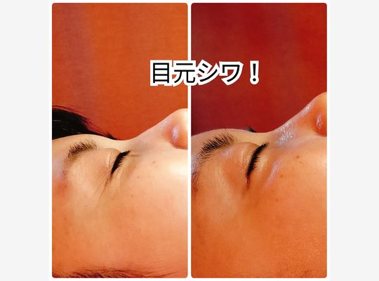 しわ改善